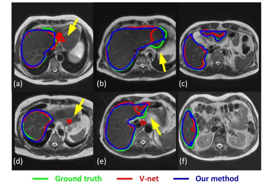Six liver MRI examples comparing ground-truth contours in green, V-net in red, and the presented method in blue.